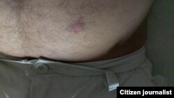 Mostrando el pinchazo que le dio el individuo agresor.